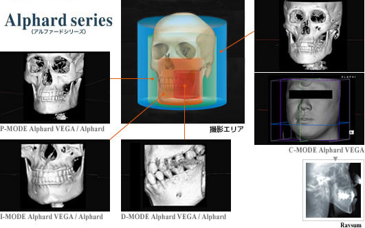 3D矯正治療CT解析
